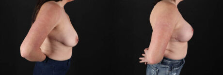 Breast Lift with Implants case #7897