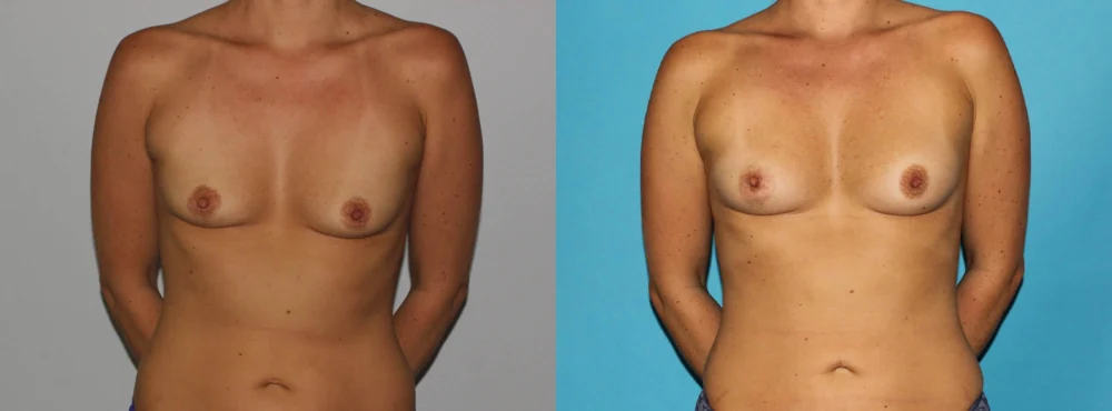 Fat Grafting to the Breast case #8051