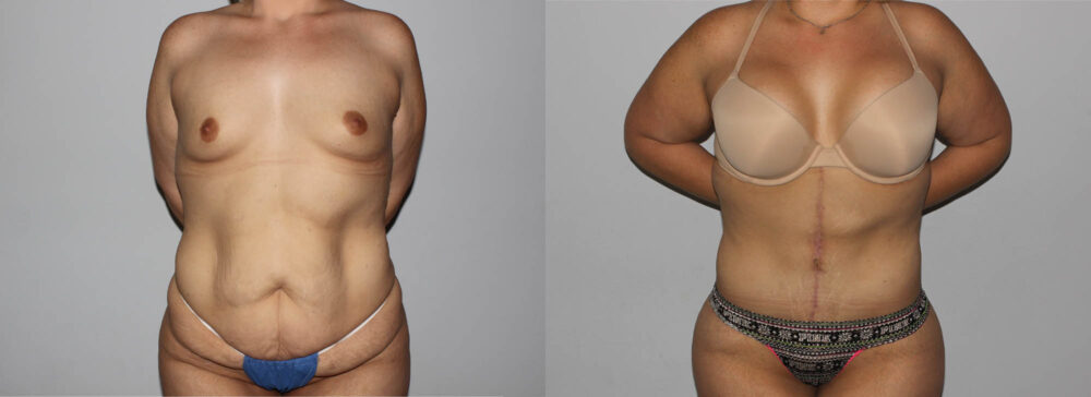 Post Bariatric Surgery (Massive Weight Loss) case #6772