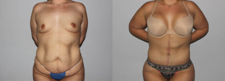 Post Bariatric Surgery (Massive Weight Loss) case #6772