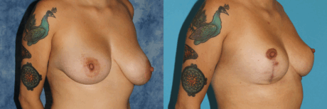 Breast Reduction case #7931