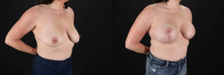 Breast Lift with Implants case #7897