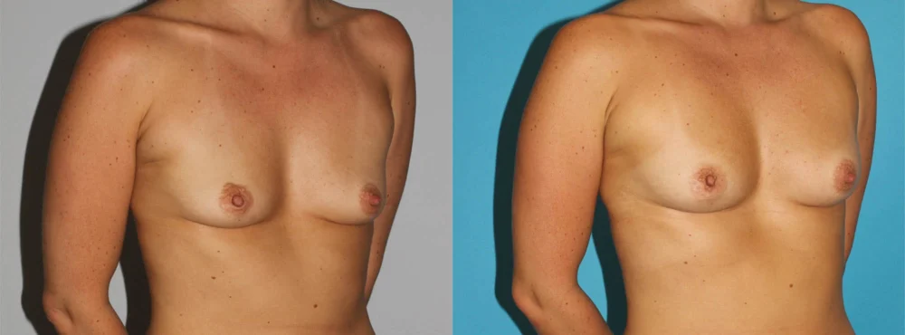 Fat Grafting to the Breast case #8051