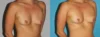 Fat Grafting to the Breast case #8051 slider thumbnail
