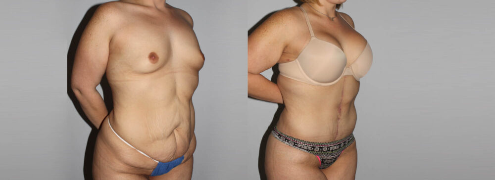 Post Bariatric Surgery (Massive Weight Loss) case #6772