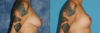 Breast Reduction case #7931 slider thumbnail