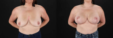 Breast Lift with Implants case #7897