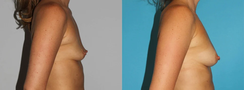 Fat Grafting to the Breast case #8051