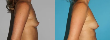 Fat Grafting to the Breast case #8051