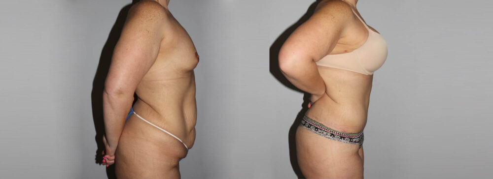 Post Bariatric Surgery (Massive Weight Loss) case #6772