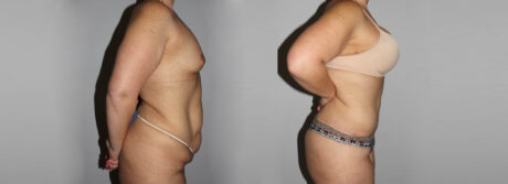 Post Bariatric Surgery (Massive Weight Loss) case #6772