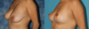 Breast Reduction case #7931 slider thumbnail