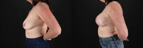 Breast Lift with Implants case #7897