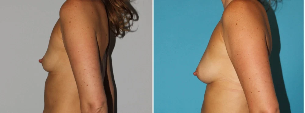 Fat Grafting to the Breast case #8051