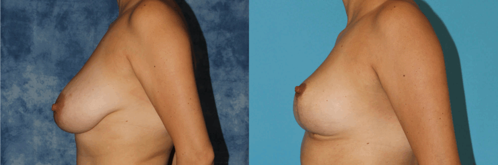 Breast Reduction case #7931