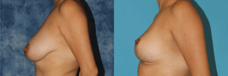 Breast Reduction case #7931