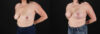 Breast Lift with Implants case #7897 slider thumbnail