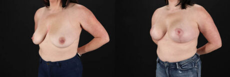 Breast Lift with Implants case #7897