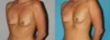 Fat Grafting to the Breast case #8051 slider thumbnail