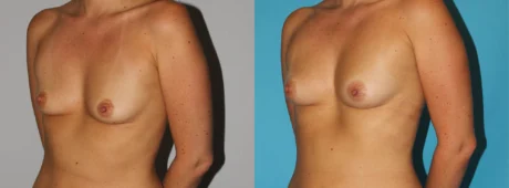 Fat Grafting to the Breast case #8051