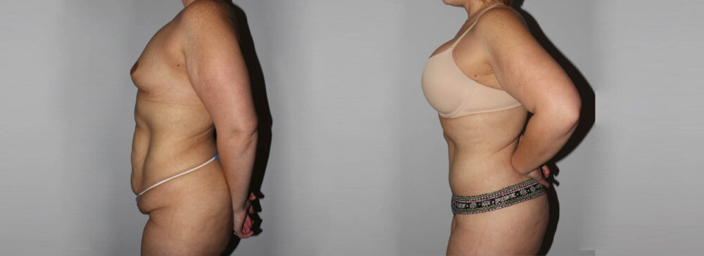 Post Bariatric Surgery (Massive Weight Loss) case #6772