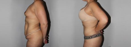 Post Bariatric Surgery (Massive Weight Loss) case #6772