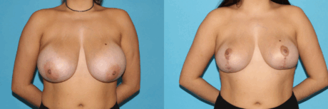 Breast Reduction case #7928