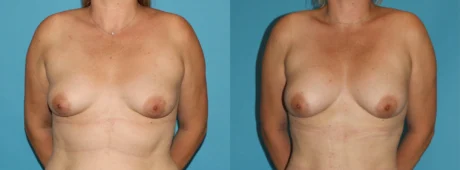 Fat Grafting to the Breast case #8044