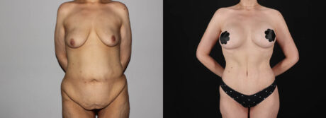 Post Bariatric Surgery (Massive Weight Loss) case #6771