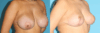 Breast Reduction case #7928 slider thumbnail