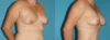 Fat Grafting to the Breast case #8044 slider thumbnail