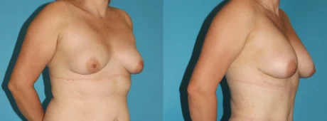 Fat Grafting to the Breast case #8044