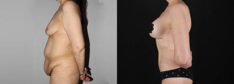 Post Bariatric Surgery (Massive Weight Loss) case #6771