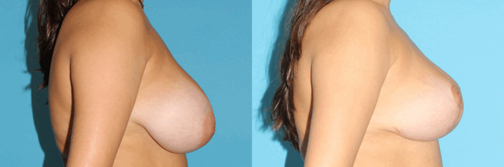 Breast Reduction case #7928