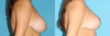 Breast Reduction case #7928 slider thumbnail