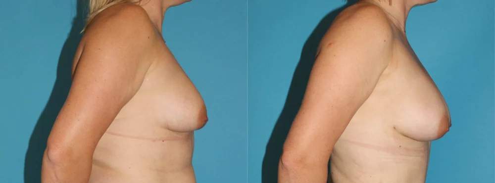 Fat Grafting to the Breast case #8044