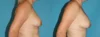 Fat Grafting to the Breast case #8044 slider thumbnail
