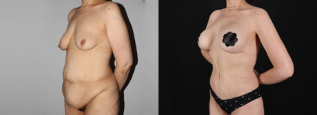 Post Bariatric Surgery (Massive Weight Loss) case #6771