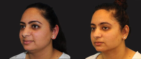 Submental Liposuction case #6946