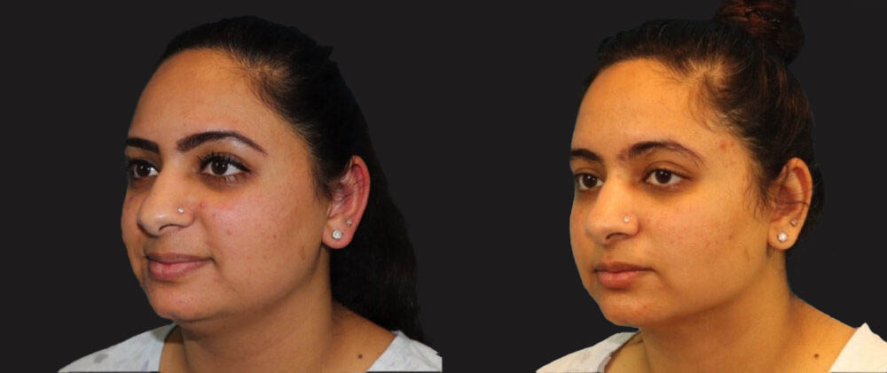 Submental Liposuction case #6946