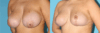 Breast Reduction case #7928 slider thumbnail