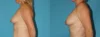 Fat Grafting to the Breast case #8044 slider thumbnail