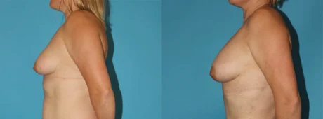 Fat Grafting to the Breast case #8044