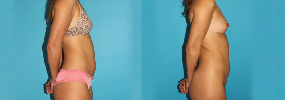 Liposuction case #5889