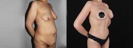 Post Bariatric Surgery (Massive Weight Loss) case #6771