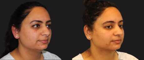 Submental Liposuction case #6946