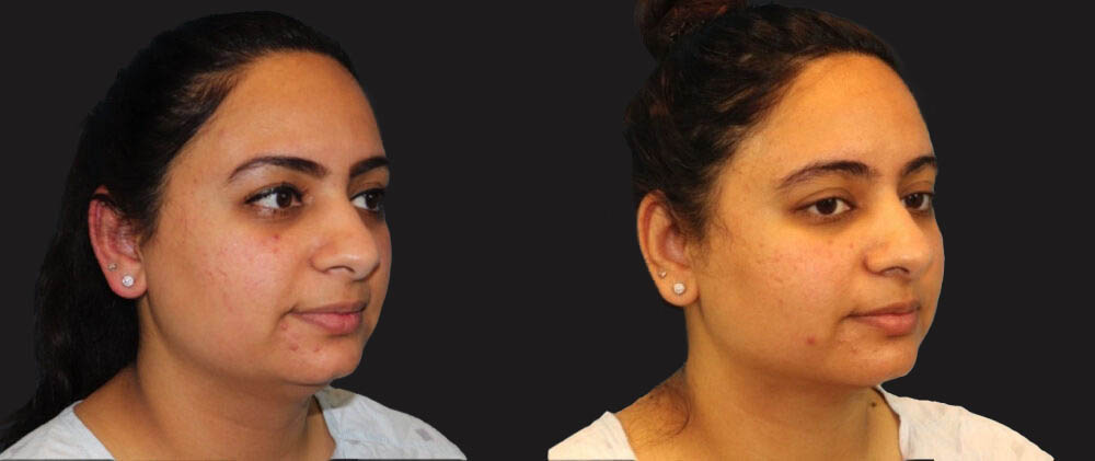 Submental Liposuction case #6946