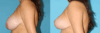 Breast Reduction case #7928 slider thumbnail