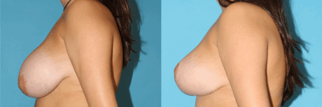 Breast Reduction case #7928