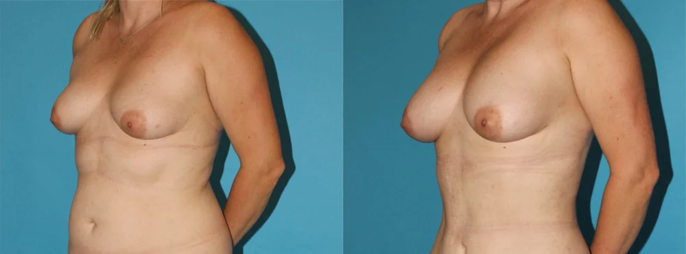 Fat Grafting to the Breast case #8044